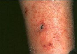 colloidal silver kills skin cancer