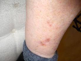 colloidal silver kills skin cancer